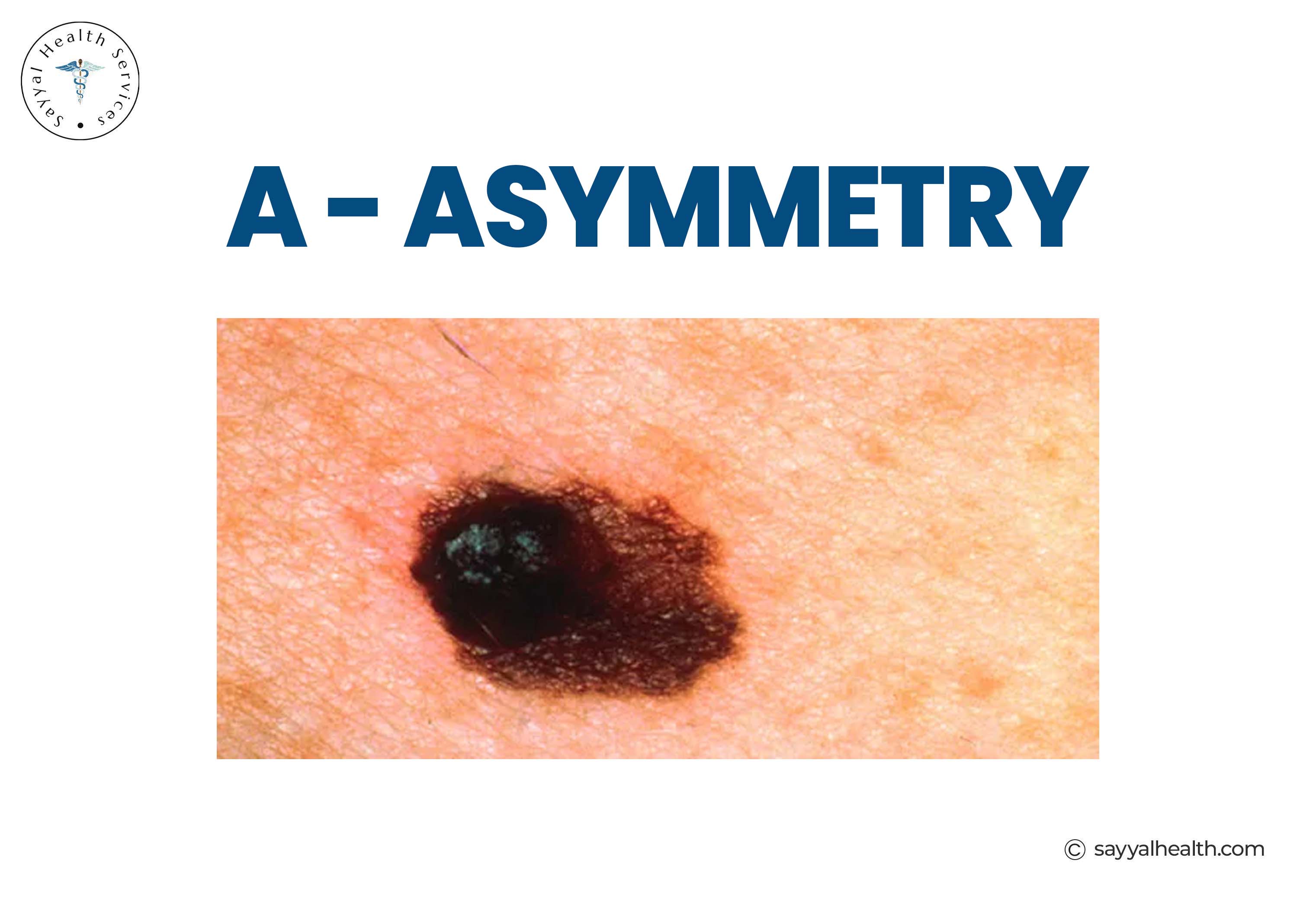 Asymmetry in melanoma - irregularly shaped dark mole